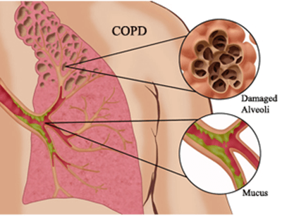 Fullform COPD 